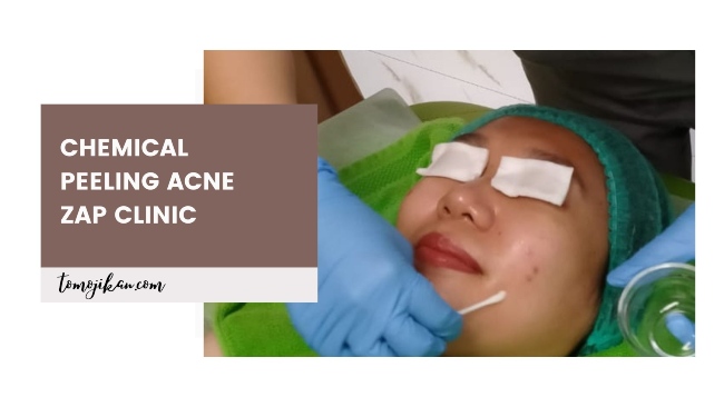 treatment chemical peeling acne zap