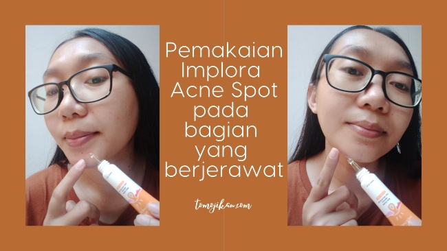 Cara pemakaian Implora Acne Gel