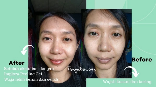 hasil eksfoliasi dengan produk implora peeling gel